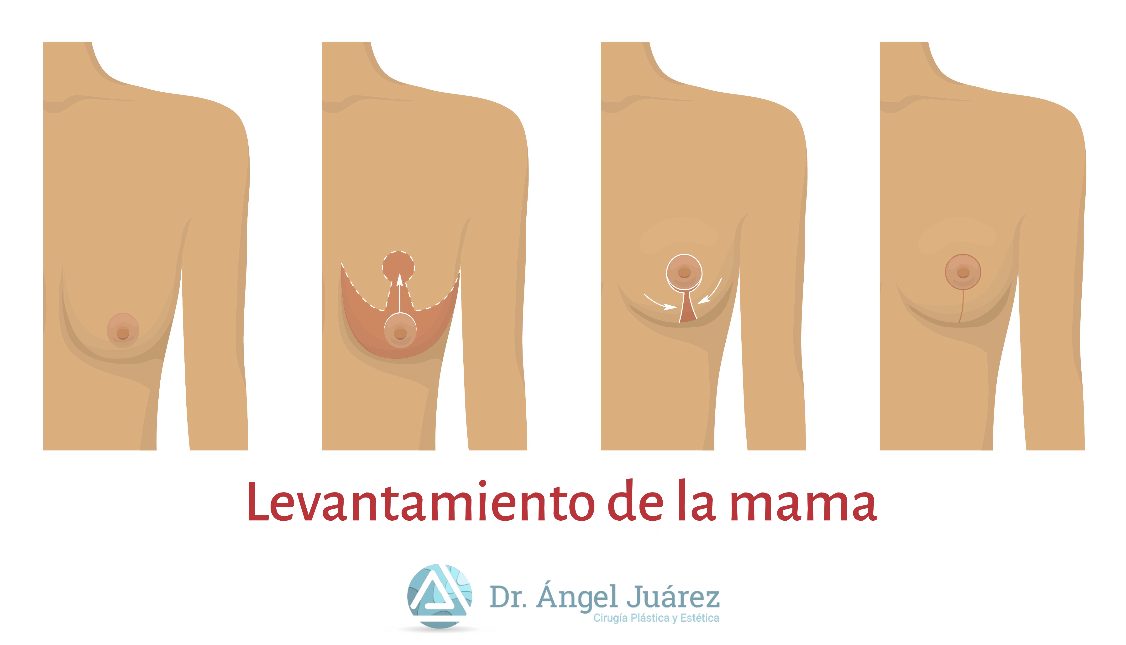 Levantamiento de la mama - Dr. Ángel Juárez
